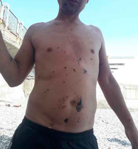 Туристы Гурзуфа возмущены масштабным загрязнением пляжей поселка. Мазут оседает на коже и волосах, пачкает песок и негативно влияет на экологическую ситуацию.