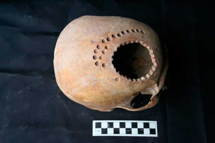 трепанация черепа в древнем Перу