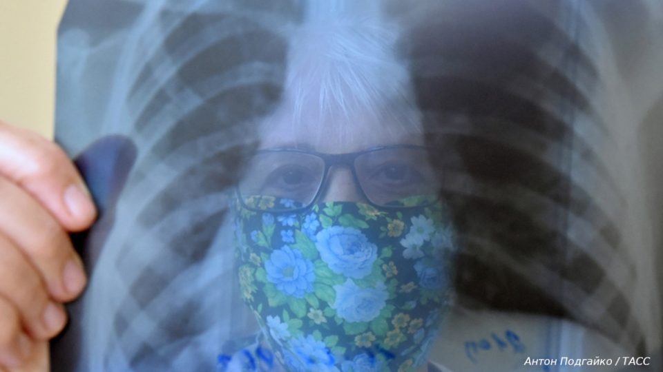пневмония рентген